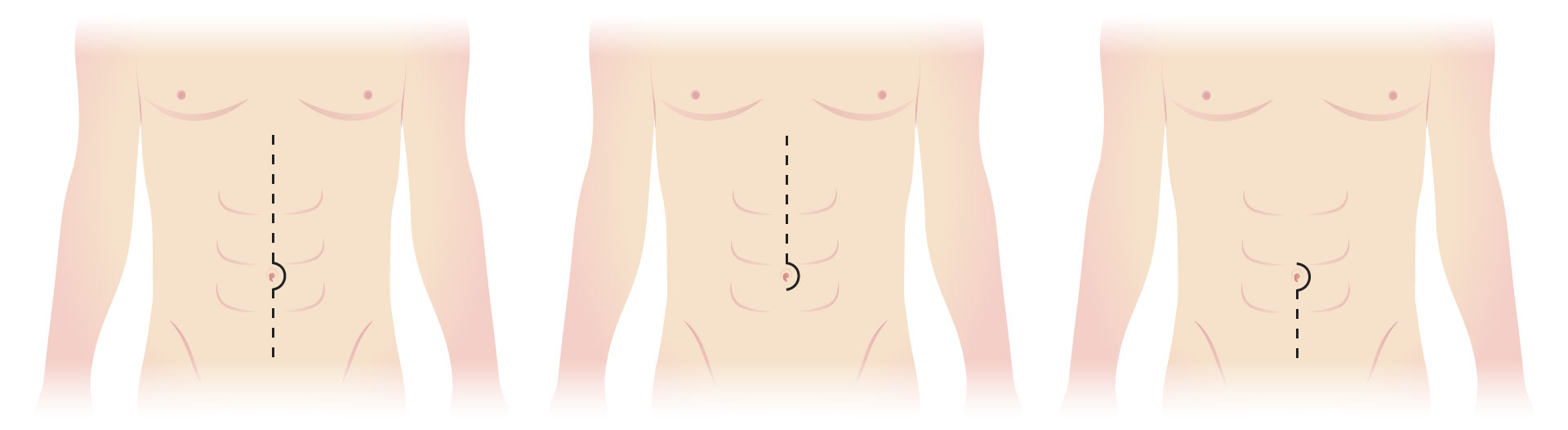 Laparotomy for Bowel Obstruction and Perforation