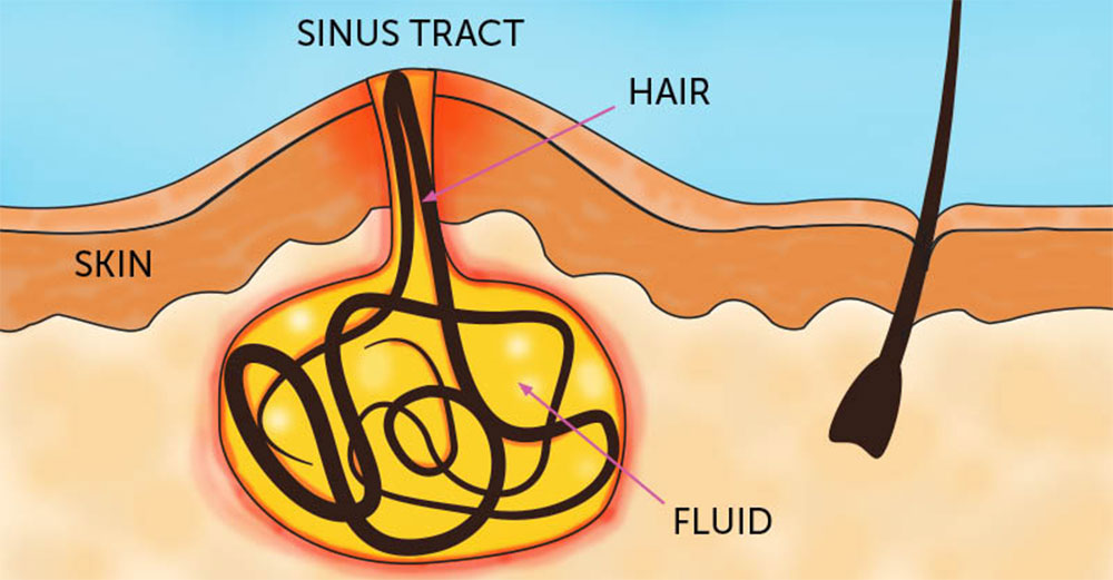 Pilonidal Sinus