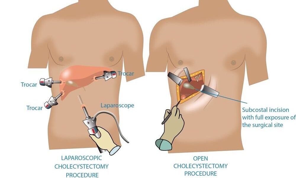 Laparoscopic-and-Open-Cholecystectomy-e1726141096260.jpg