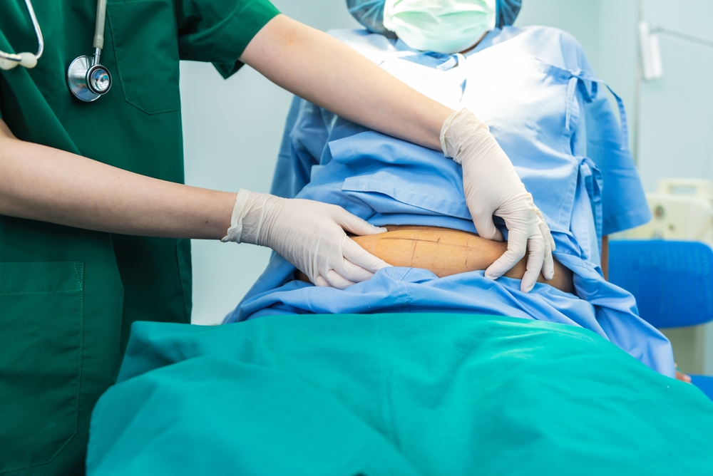 What is Laparotomy and How is it Used for Bowel Obstruction?