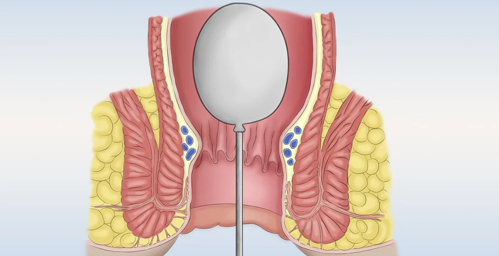 anorectal-manometry-measure.webp