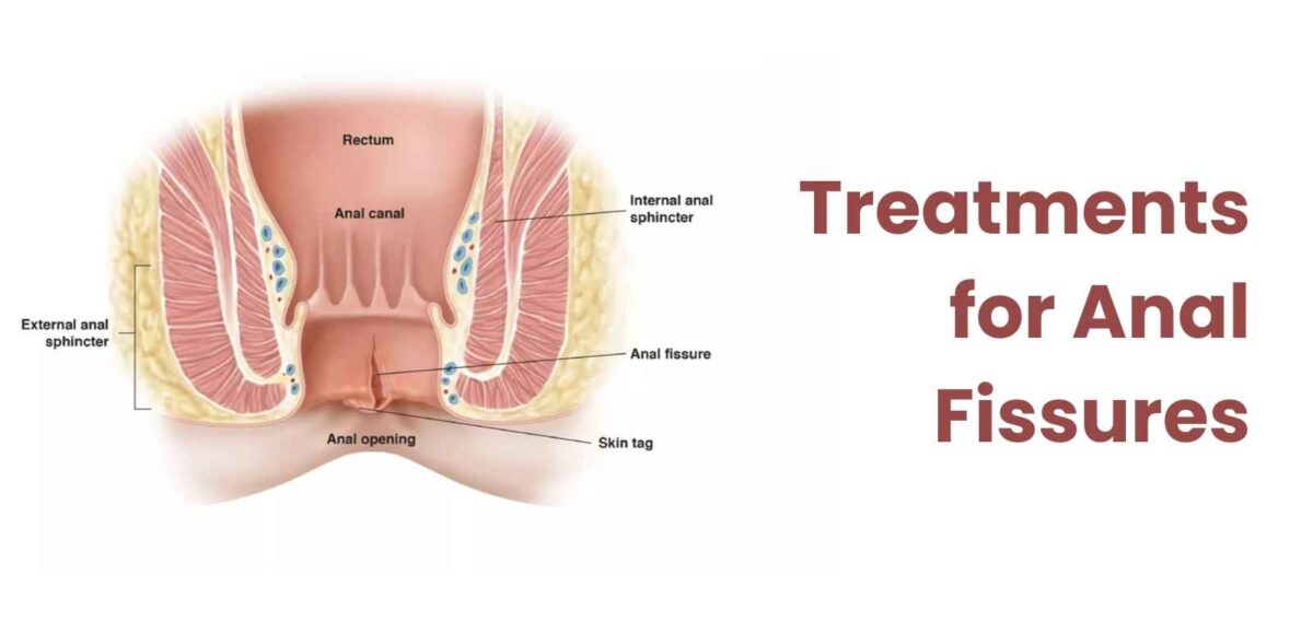 What-Are-the-Common-Causes-of-Anal-Fissures-1200x570.jpg